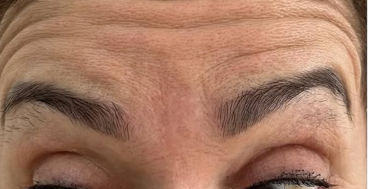Antes: Toxina botulínica