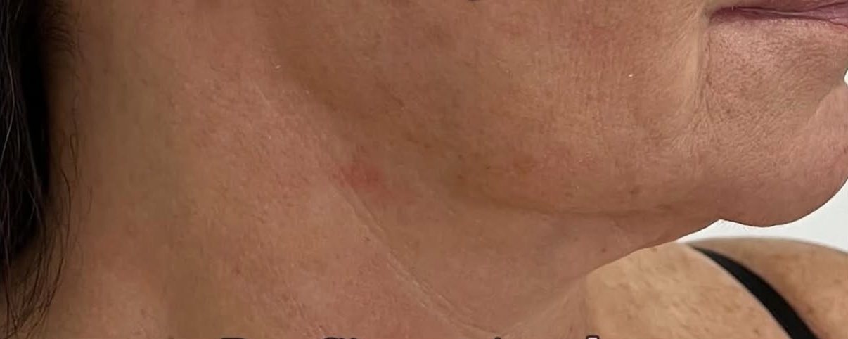 Antes: Perfil